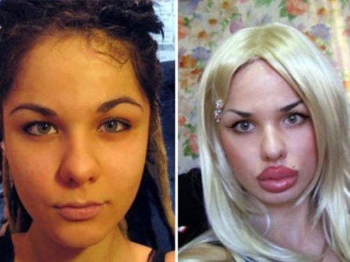 Пластична операция на момиче преди и след